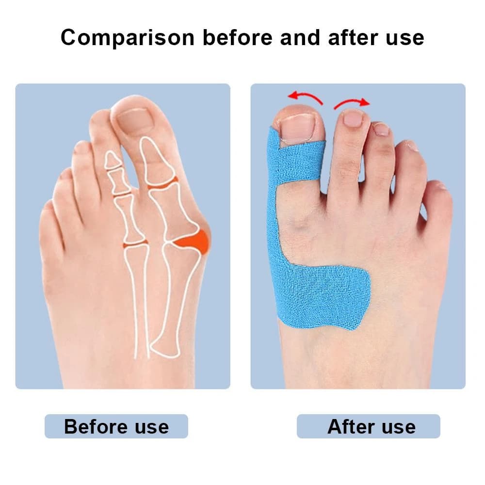 10 Pcs Kinesiology Tape for Bunion Corrector Big Toe Support Foot Pain Relief — image 4